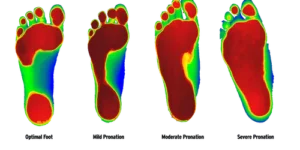 Photo of the four different types of flat feet and one normal one.